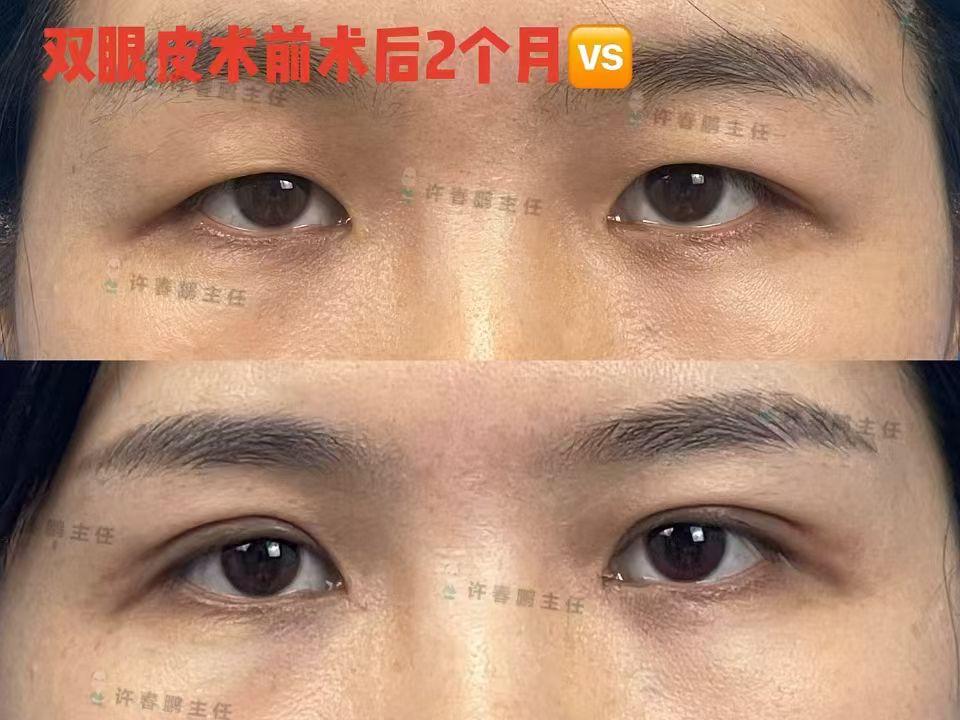 许春鹏医生鼻整形案例 1
