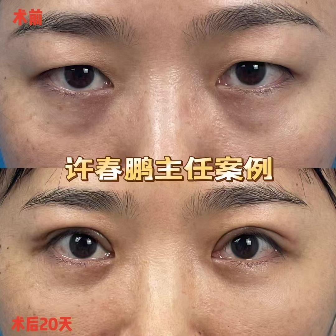 许春鹏医生鼻整形案例 2