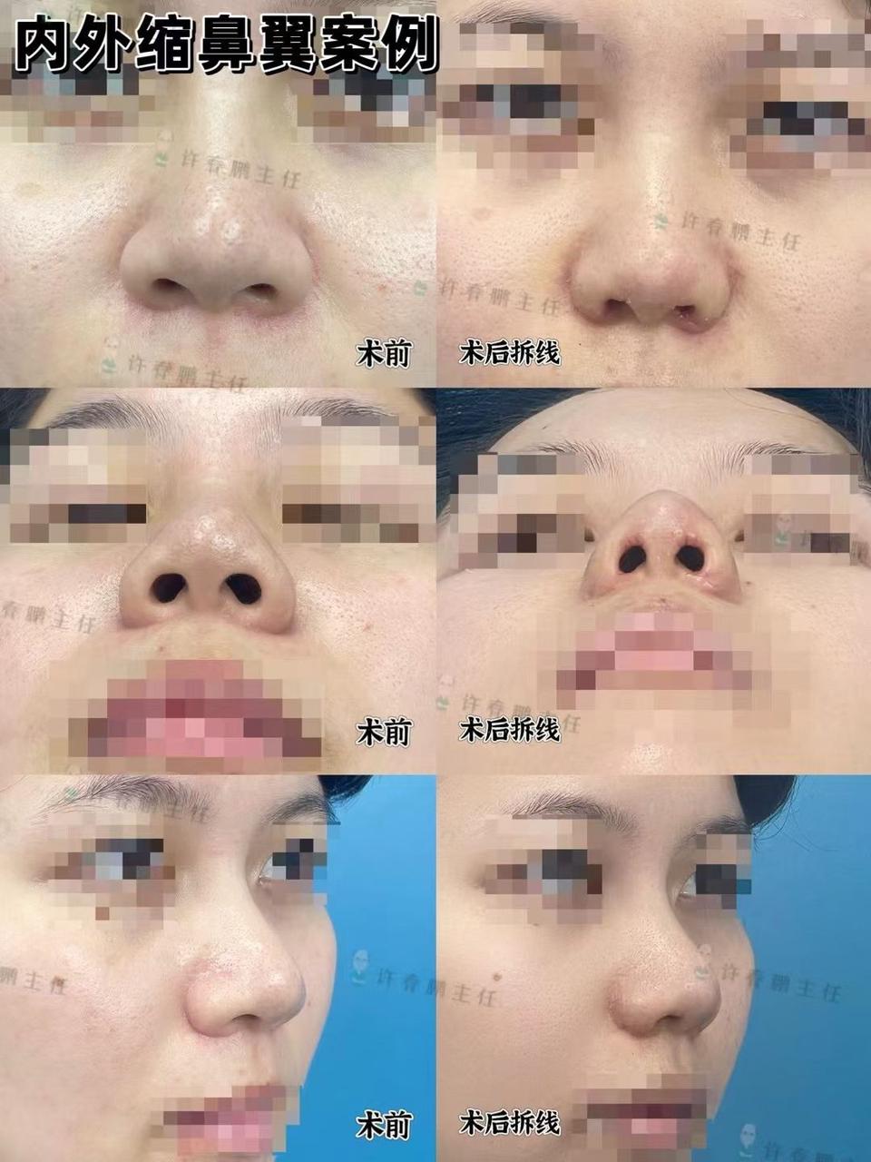许春鹏医生鼻整形案例 4