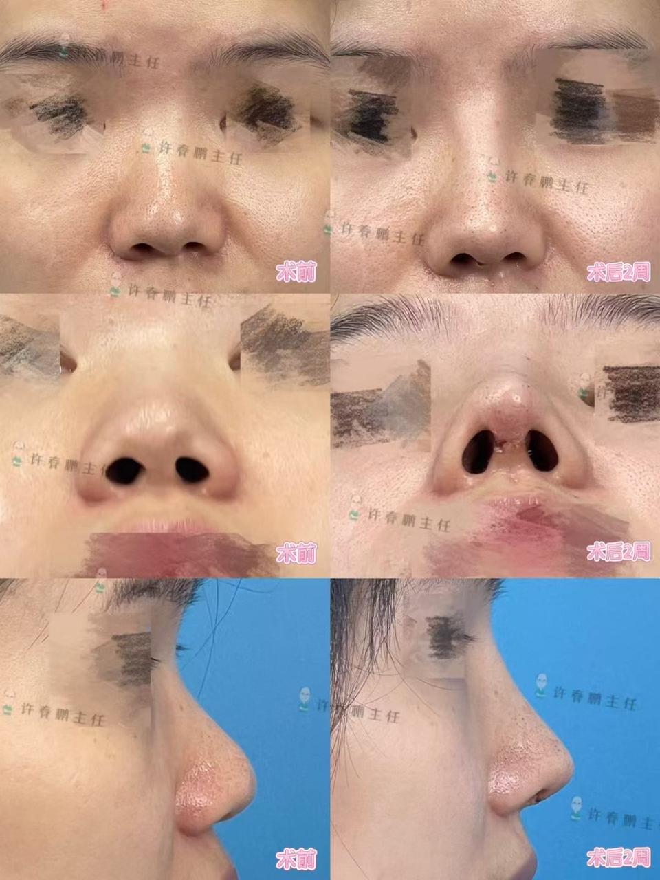 许春鹏医生鼻整形案例 5