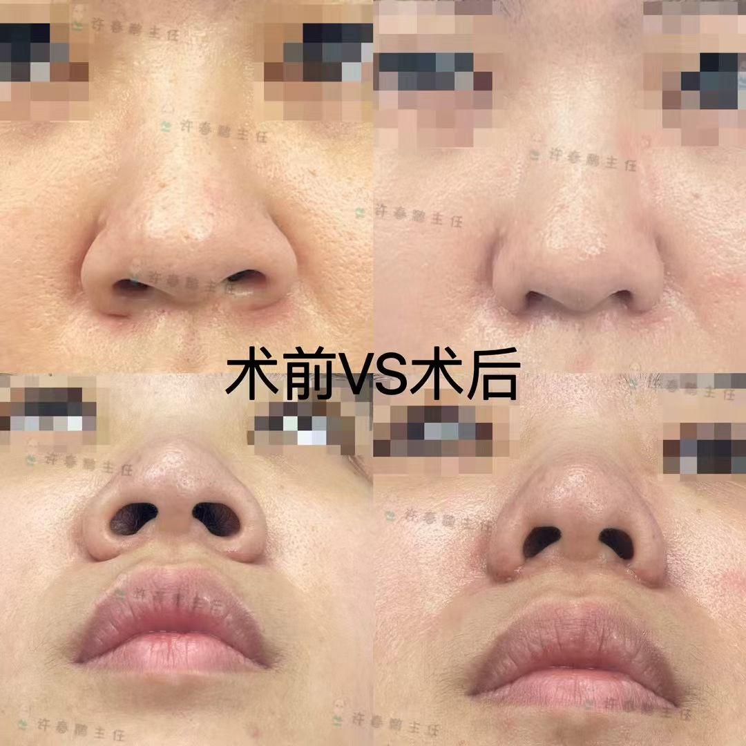 许春鹏医生鼻整形案例 6