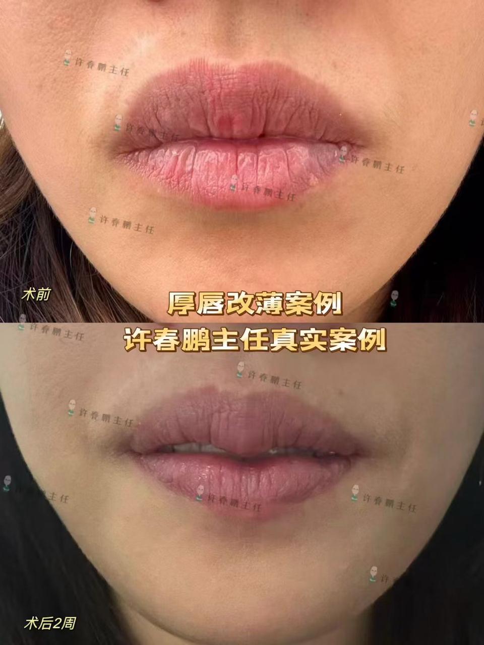 许春鹏医生唇整形案例 3