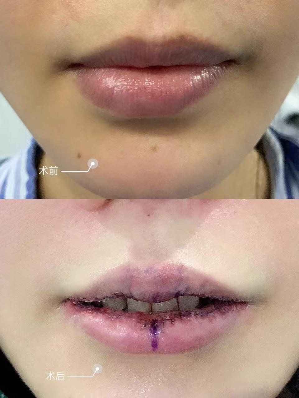 许春鹏医生唇整形案例 4