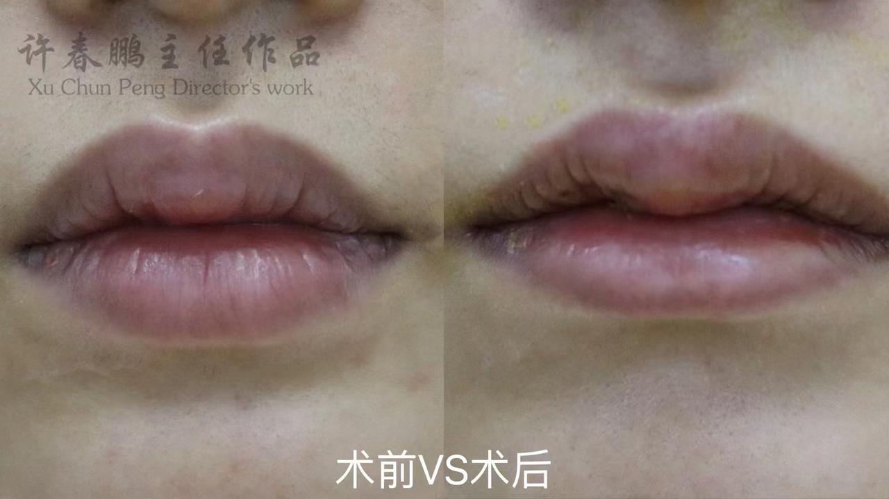 许春鹏医生唇整形案例 5