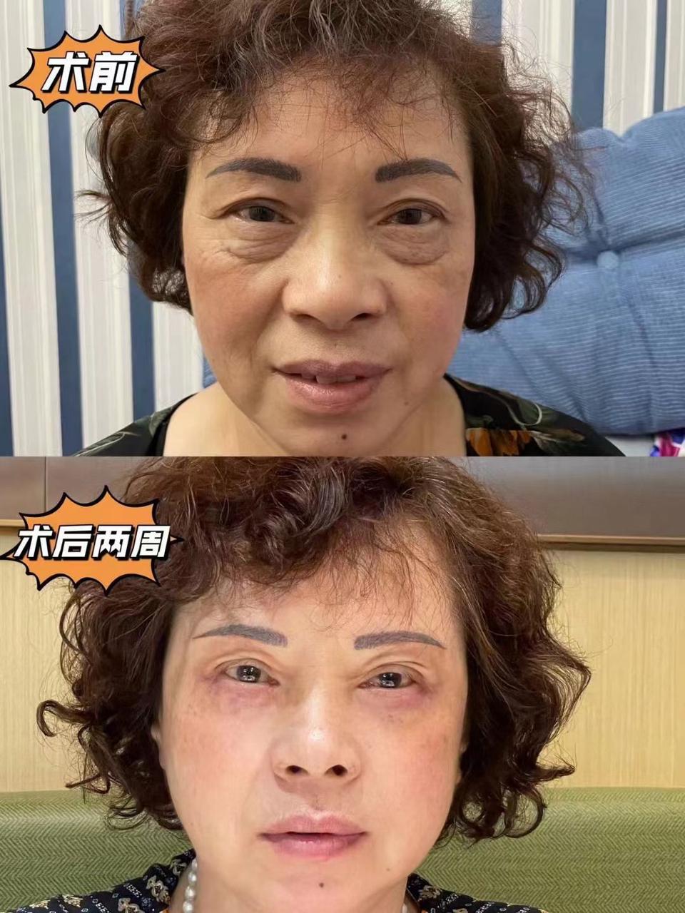 许春鹏医生腹壁成型案例 1