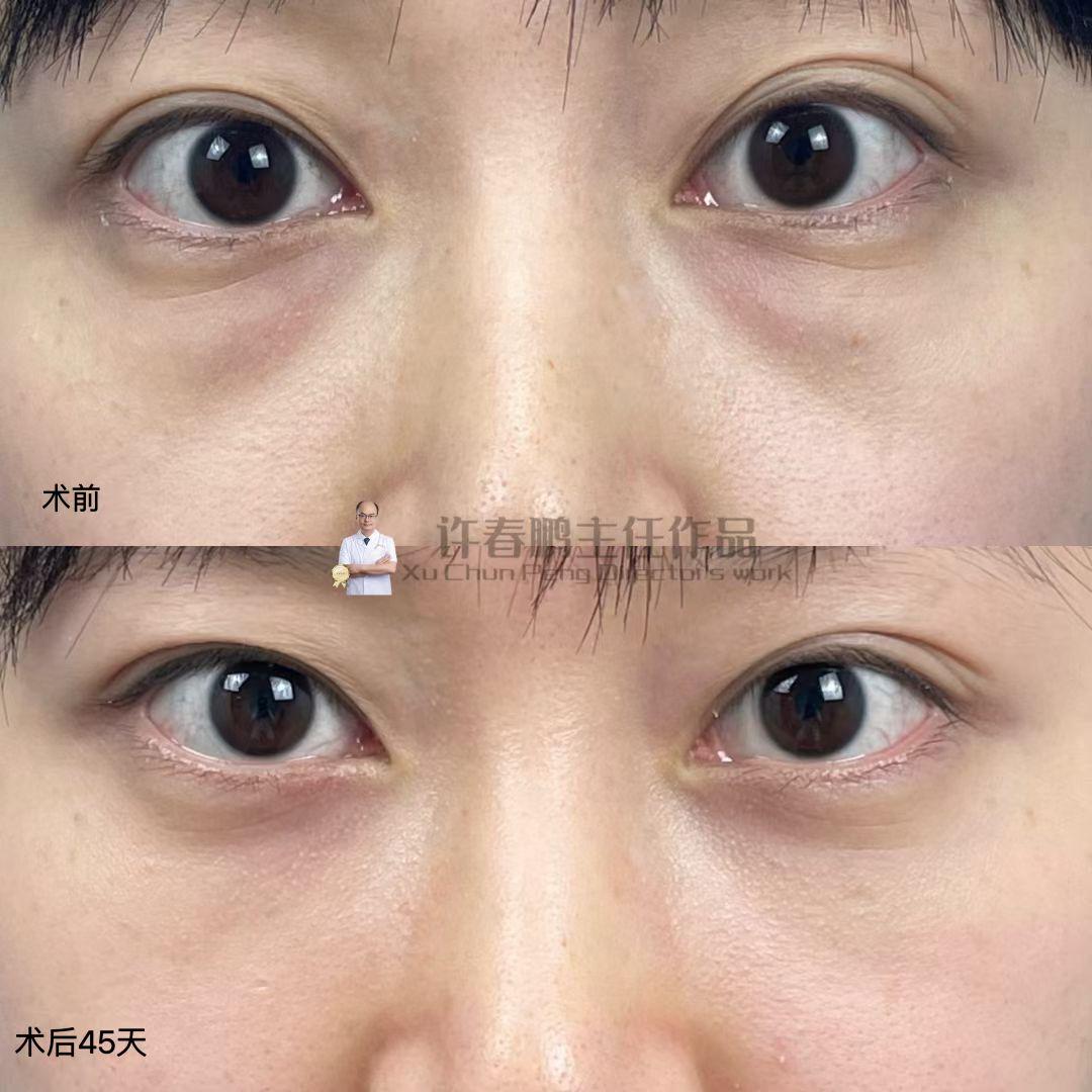 许春鹏医生腹壁成型案例 2