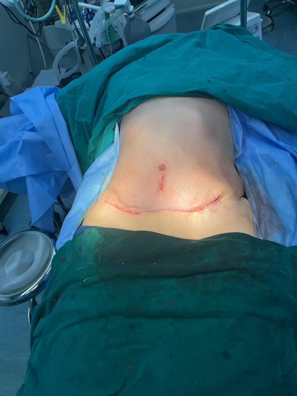 许春鹏医生腹壁成型案例 3