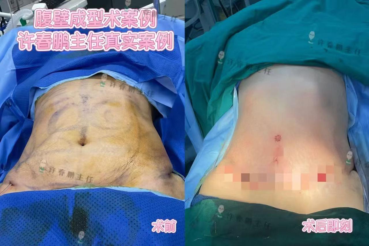 许春鹏医生腹壁成型案例 4