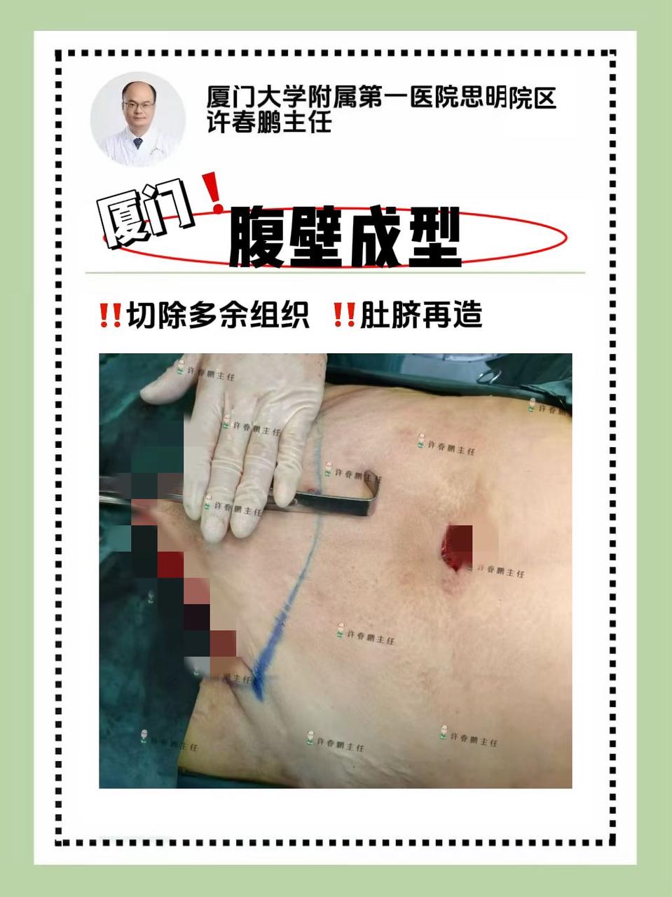 许春鹏医生腹壁成型案例 5