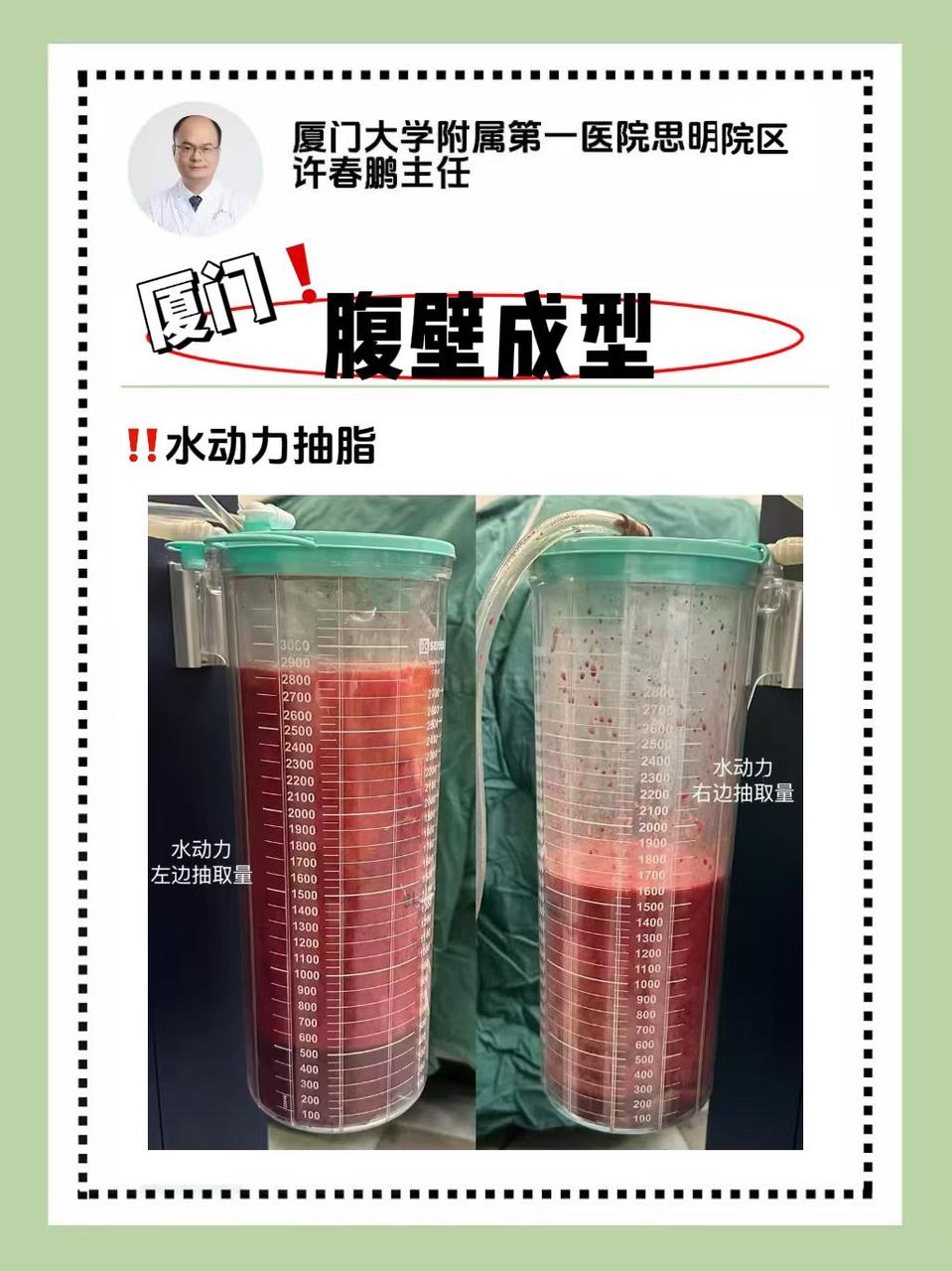 许春鹏医生腹壁成型案例 6