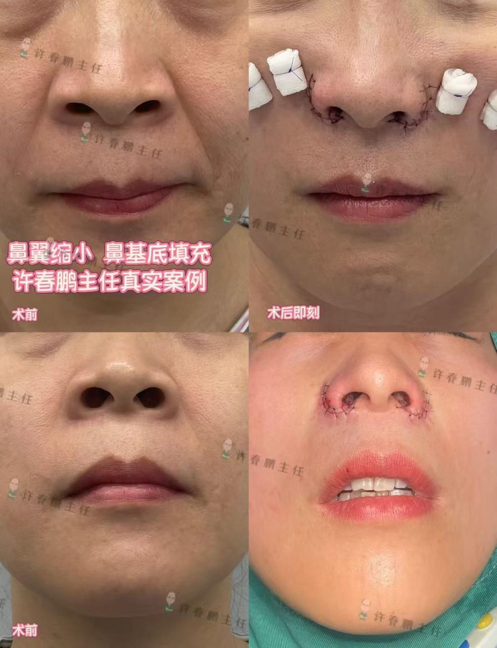许春鹏医生隆胸案例 2