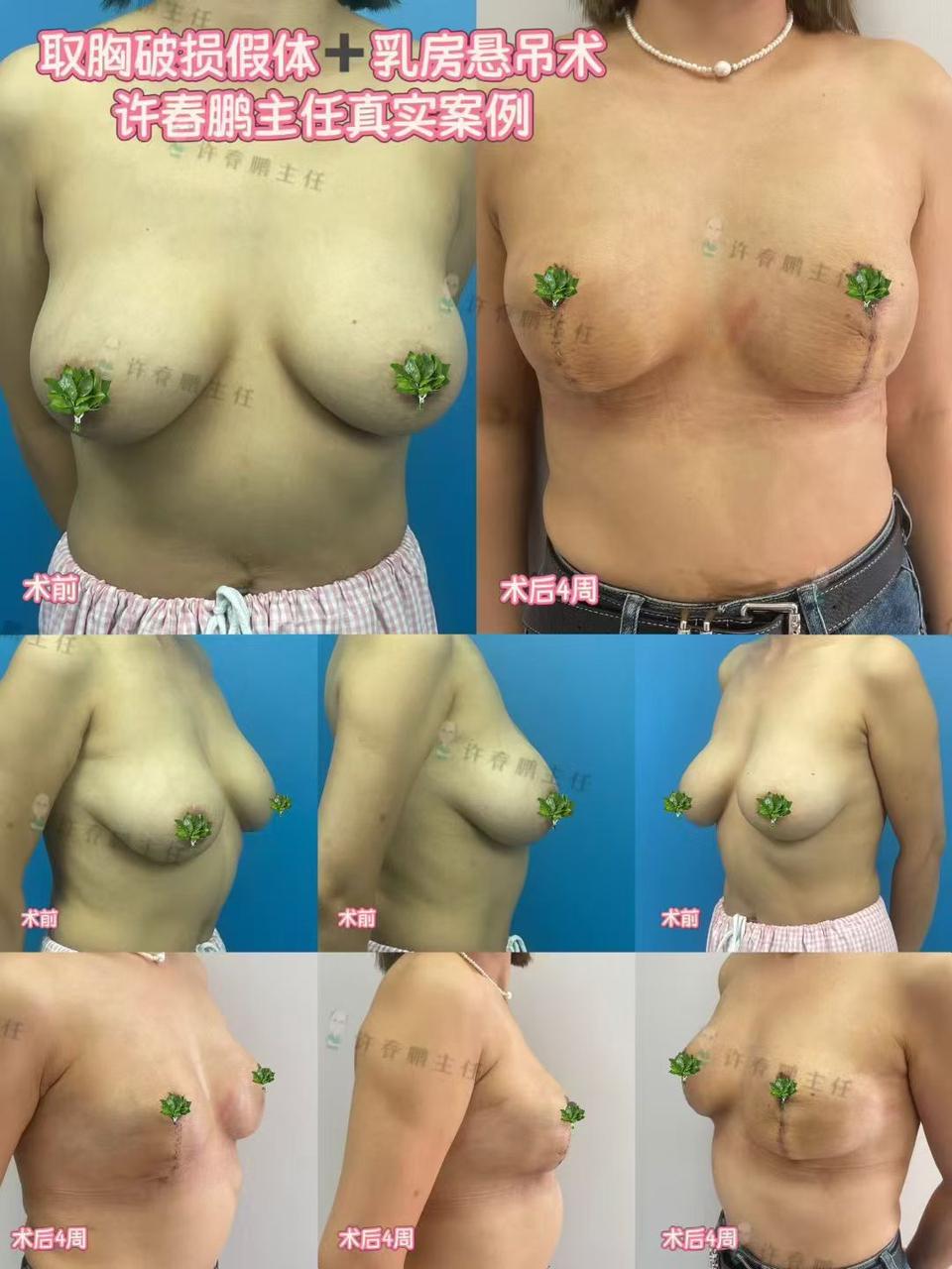 许春鹏医生隆胸案例 5