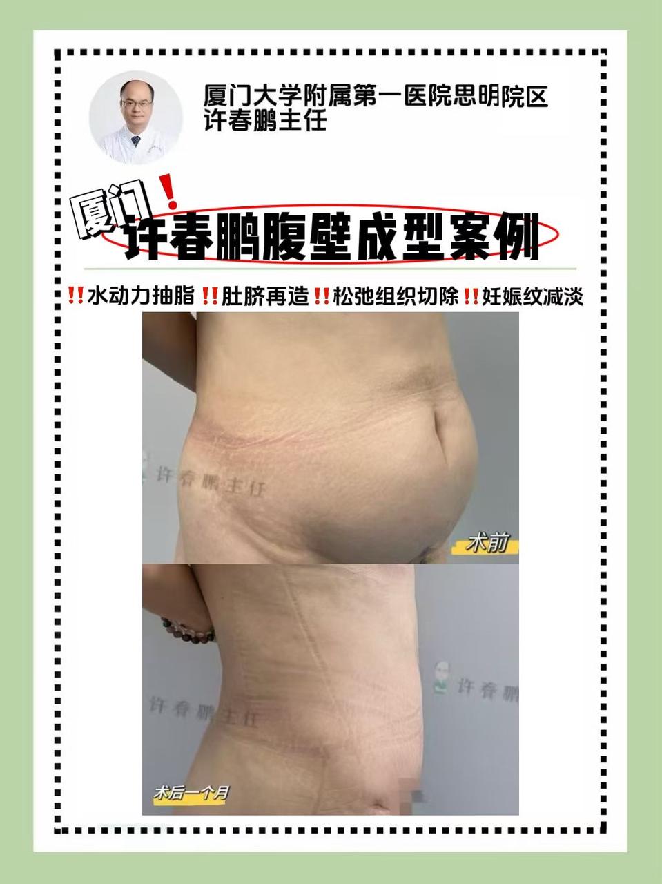 许春鹏医生双眼皮案例 1