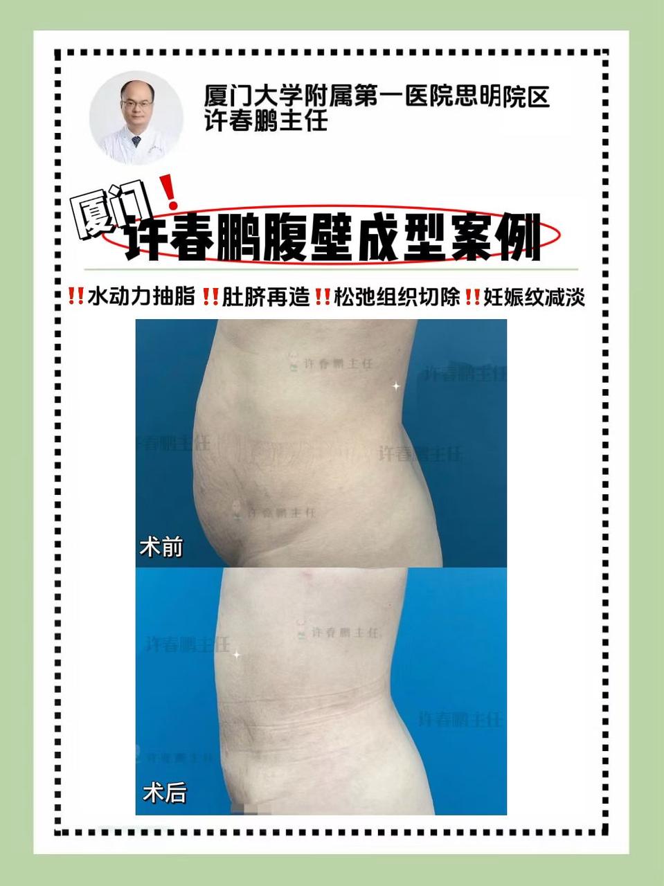 许春鹏医生双眼皮案例 2