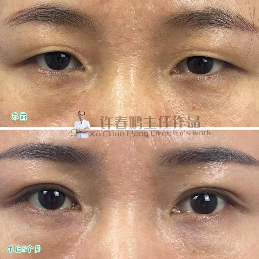 许春鹏医生双眼皮案例 3