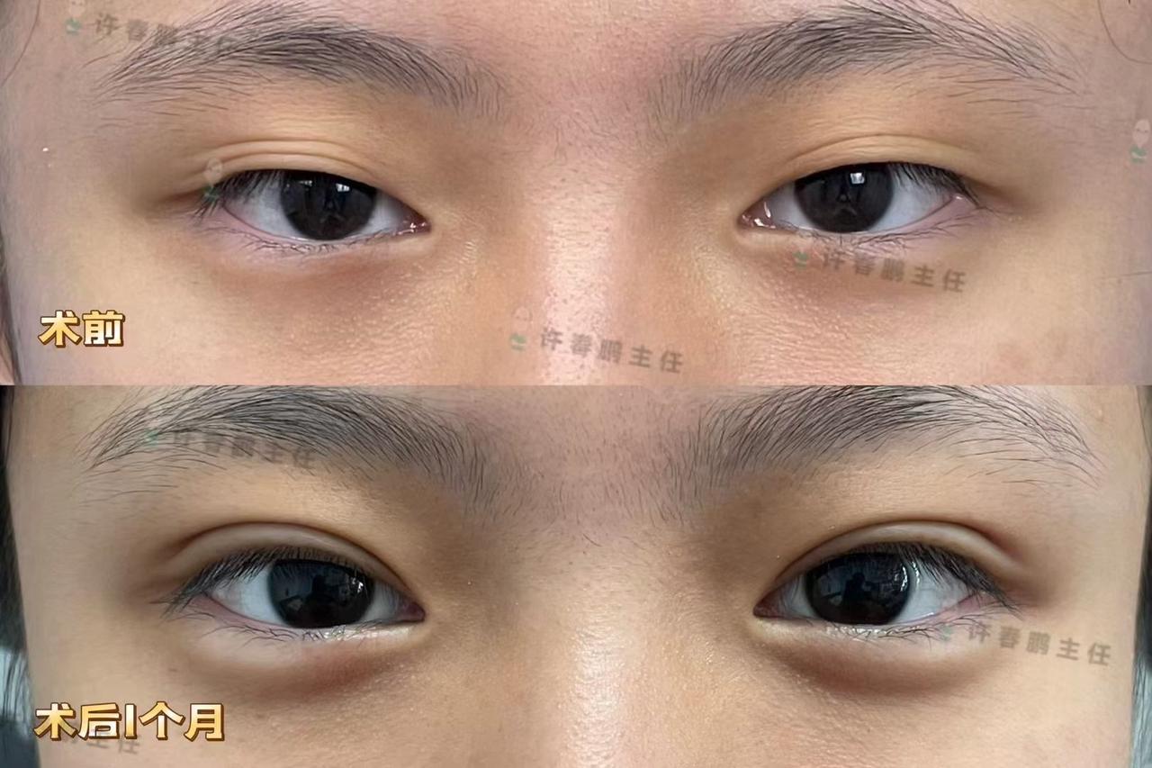 许春鹏医生双眼皮案例 4
