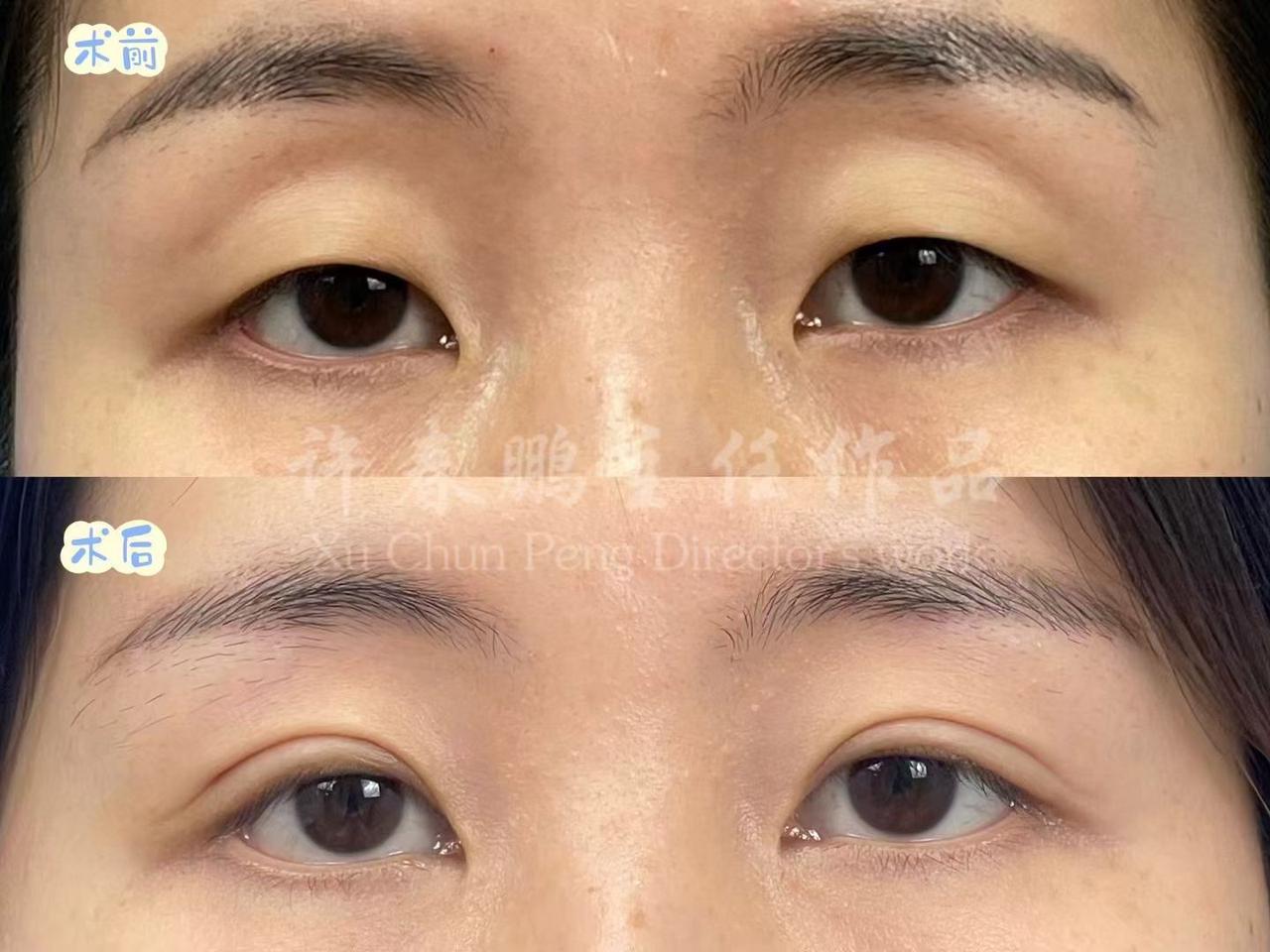 许春鹏医生双眼皮案例 5
