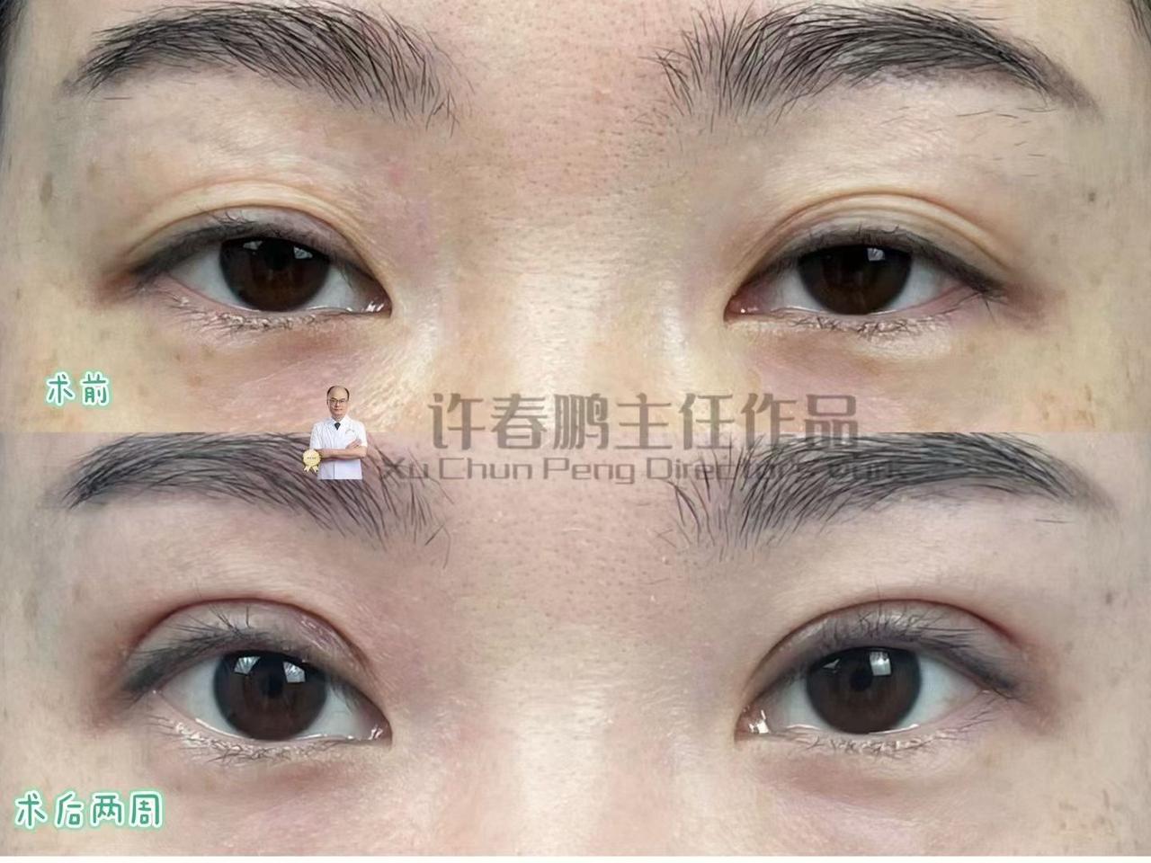许春鹏医生双眼皮案例 6