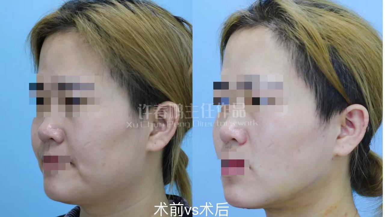 许春鹏医生吸脂案例 2