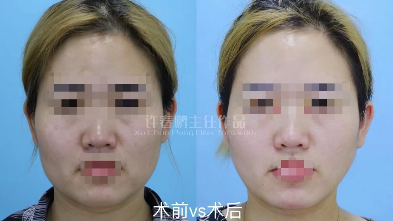 许春鹏医生吸脂案例 3