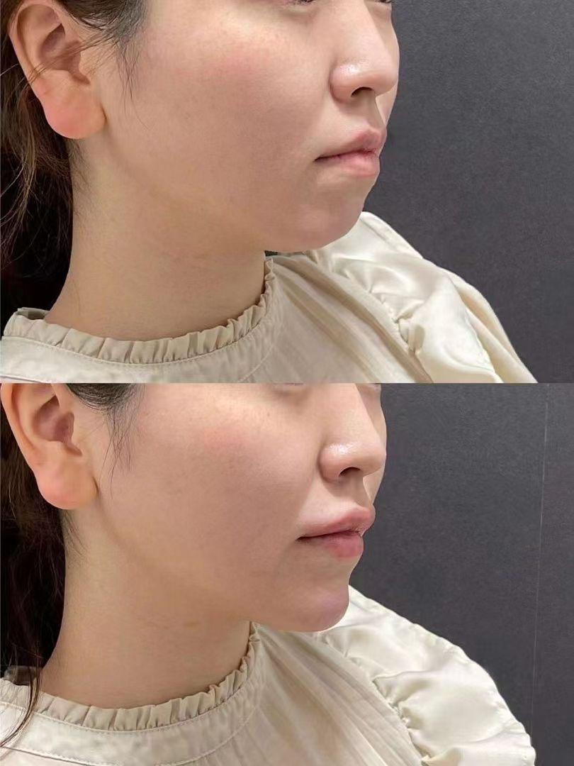 许春鹏医生吸脂案例 4
