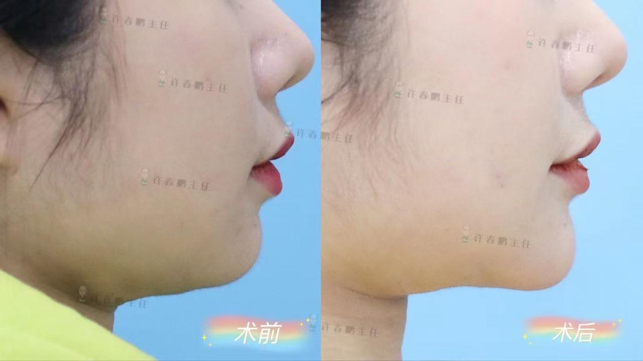 许春鹏医生吸脂案例 5